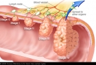 Inteligenta artificiala poate depista cancerul la colon cu mare precizie