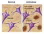 Alimente ce te protejeaza contra maladiei Alzheimer