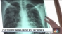 Epidemia de pneumonie a plămânului alb ia amploare la nivel mondial în rândul copiilor