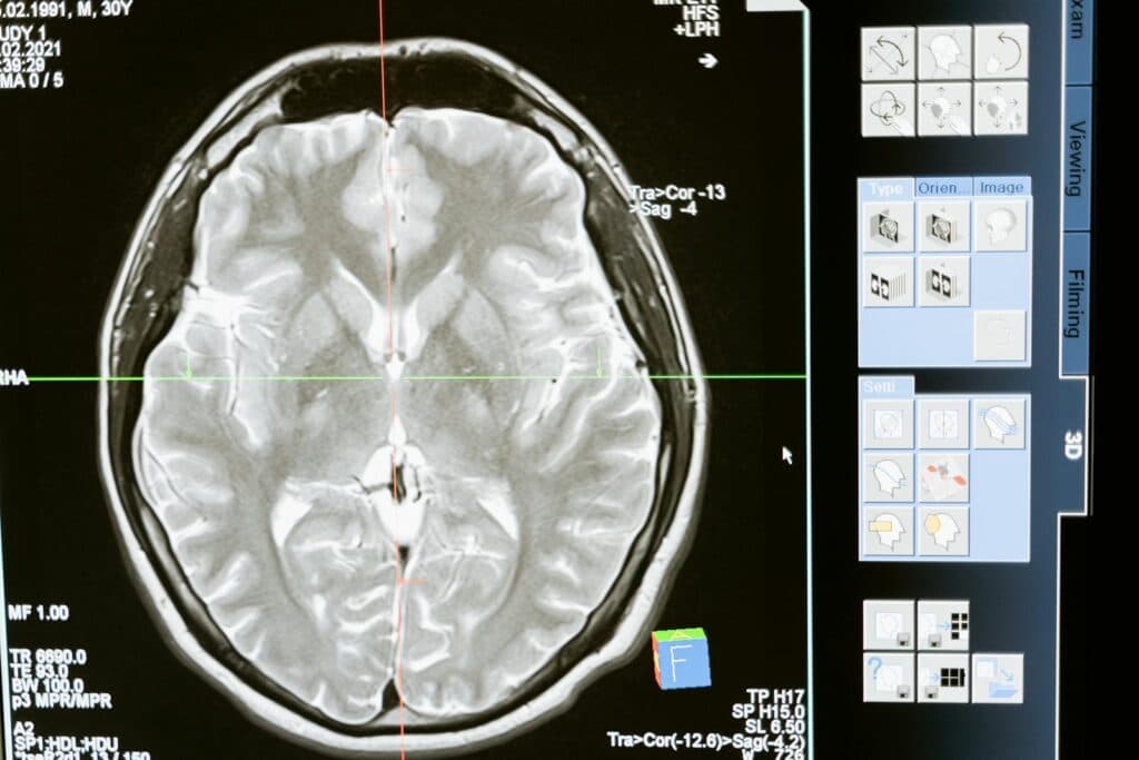 Primul Brain Scan al momentului morții arată care ar putea fi ultimele noastre gânduri