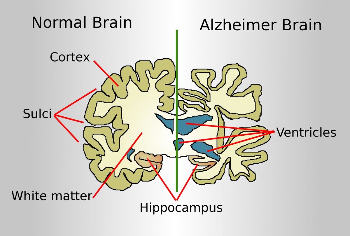 Un instrument AI poate prezice boala Alzheimer din tiparele de vorbire
